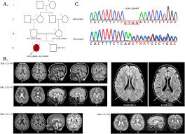 This is a good thing and useful even if udp connections are used by default. Novel Imaging And Clinical Phenotypes Of Condsias Disorder Caused By A Homozygous Frameshift Variant Of Adprhl2 A Case Report Bmc Neurology Full Text