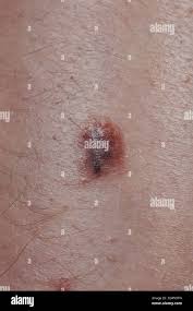 Image result for Spitz Nevus