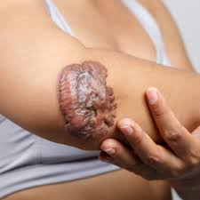 So for this reason has never got a tattoo as doesn't want to risk it. What If I M Prone To Keloids Is Plastic Surgery Still An Option North Texas Plastic Reconstructive Surgery
