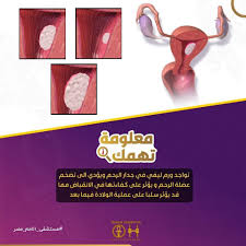من اماكن تواجد الورم الليفي المؤثرة على المرأة بشكل كبير هى تواجد ورم ليفي في جدار الرحم ويؤدي إلى تضخم عضلة الرحم و يؤثر على كفاءتها في الانقباض مما قد يؤثر