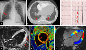 Manage these post covid cardiovascular. Delayed Isolated Peri Myocarditis In A Covid 19 Patient With Respiratory Symptoms But Without Lung Involvement Springerlink