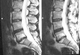 Prof Dr Christian Woiciechowsky Neurochirurgie Berlin Postdiscektomie Syndrom