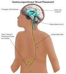 Vp Shunt Ventriculoperitoneal Shunt For Hydrocephalus Psychlopedia