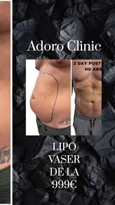 Transformă-ți corpul cu liposucția HD la Adoro Clinic