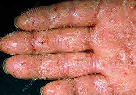 Image result for contact dermatitis