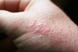 Image result for sweat rash on back