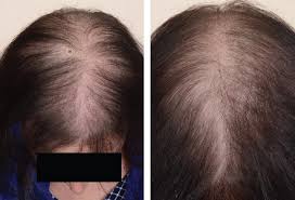 I have learned a thing or two when it comes to various ways to manage very thin, stringy, and even sparse thinning tresses! Male And Female Pattern Hair Loss Treatable And Worth Treating Cleveland Clinic Journal Of Medicine