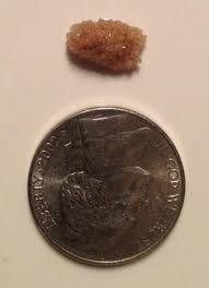 Kidney Stone I Passed Hadtohurt