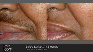 Denton watumull to learn more about the results you can achieve with laser hair removal. Icon Laser Hair Removal Rockwall Tx Graceful Wellness
