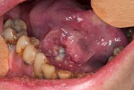 Image result for mouth cancer