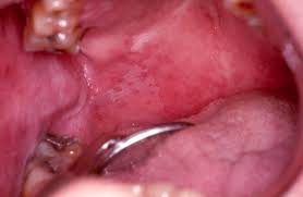 Image result for Physical injury red spots roof of mouth