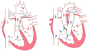 完全大血管転位症（指定難病２０９） – 難病情報センター