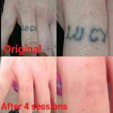 Work In Progress This Dinky Tattoo On My Client S Finger Has Faded Dramatically After 4 Laser Sessions No Regrets Tattoo Laser Tattoo Removal Tattoo Removal