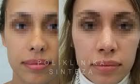Hier entsteht eine neue webseite! Nasenoperation Rhinoplastik Vom Experten Zagreb Kroatien