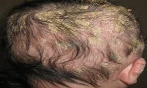 While one baby may be born with a full head of hair, another may seem almost bald at birth. Conditions That Cause Hair Loss In Children Causes And Their Verified Treatments Babygogo
