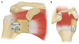 Related online courses on physioplus. Anterior Capsule Reconstruction Springerlink
