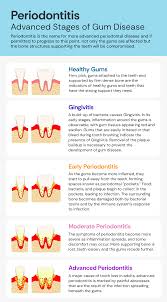 Image result for Gingivitis