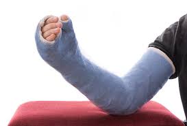 Image result for Long Arm Cast