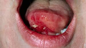 Image result for Puchýře na jazyku