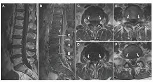 We did not find results for: Guillain Barre Syndrome And Low Back Pain Two Cases And Literature Review