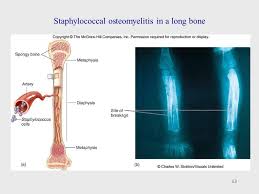 Image result for Osteomyelitis