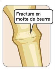 Le Doc Ar Twitter C Est Une Fracture Dite En Motte De Beurre Un Classique De L Enfant De 2 A 12 Ans