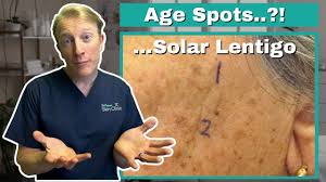 Image result for Solar Lentigo