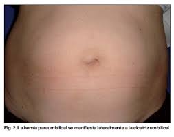 Nuestra Conducta En La Asociacion De Hernia De Pared Y Abdominoplastia Estetica