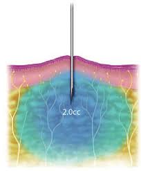 Image result for Local Skin Anesthesia