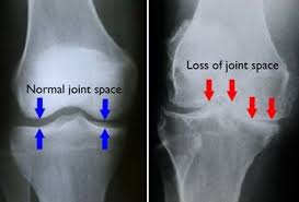 X Ray Of Arthritis In The Knee Compared To A Normal Knee Joint Note The Loss Of Joint Space Knee Arthritis Arthritis Treatment Osteoarthritis