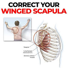 Image result for Winged Scapula