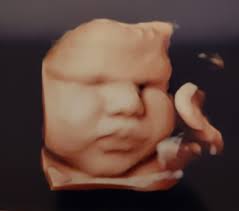 Check spelling or type a new query. Ob Pregnancy 2d 3d 4d Ultrasound Procare Ultrasound