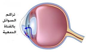 الجلوكوما الماء الأزرق المياه الزرقاء