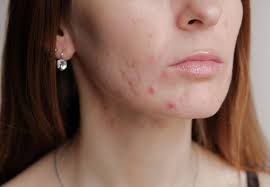 To help get rid of acne under the skin, dermatologists often inject a corticosteroid. What Does It Mean When Acne Is On Certain Areas Of Your Face Health Essentials By Cleveland Clinic Health Essentials From Cleveland Clinic
