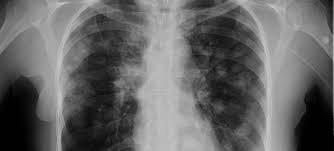 If cancer cells are blocking the lymph nodes in. Metastatic Breast Cancer In The Lungs Symptoms And Diagnosis