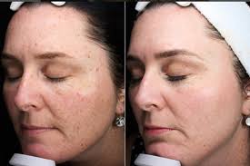 The Latest On Lasers: A Cutera Press Event With Dr. Neil Sadick