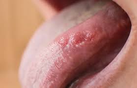 Image result for white cancer on tongue)