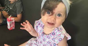 Help this little girl born with facial birthmark raise funds for surgery