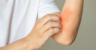 Image result for Anemia