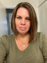 Will hair loss be bad after bariatric surgery with already thin hair?