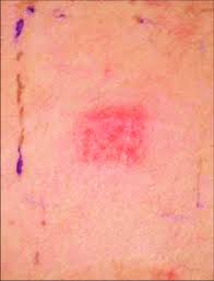 Check the full list of possible causes and conditions now! Patch Test Positive Reaction To Ppd Download Scientific Diagram