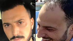 I motivi per cui scelgono la turchia, per sottoporsi a un innesto di capelli, sono diversi, tra i quali rilevano l'ampia offerta, la qualità dei . Trapianto Di Capelli In Turchia Una Scelta Raccomandabile La Repubblica