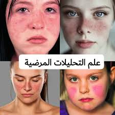 Symptoms vary between people and may be mild to severe. Ù…Ø±Ø¶ Ø§Ù„Ø°Ø¦Ø¨Ø© Ø§Ù„Ø­Ù…Ø±Ø§Ø¡ Ø§Ù„Ø¹Ø§Ù… Systemic Ø¹Ù„Ù… Ø§Ù„ØªØ­Ù„ÙŠÙ„Ø§Øª Ø§Ù„Ù…Ø±Ø¶ÙŠØ© Facebook