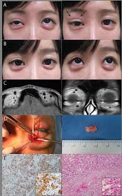 Eyelid-associated complications after autogenous fat injection for cosmetic  forehead augmentation