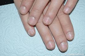Der text ist unter der lizenz „creative commons attribution/share alike verfügbar; Kurzes Nagelbett Verlangern Verkurzte Fingernagel Fussnagel