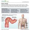 Colorectal growth, likewise called colon tumor, is the second driving reason for disease passings in the us. 1