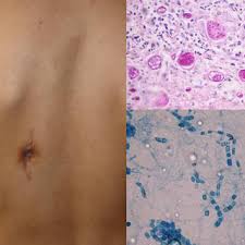 En la población adulta es más frecuente en pacientes diabéticos mal controlados, con cetoacidosis1,11,34. Mucormicosis Rinocerebral Cutanea En Paciente Diabetico Descompensado Download Scientific Diagram