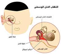 إلتهاب الأذن الوسطى إلتهاب الأذن الوسطى وعلاجها ويب طب