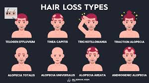 Image result for Alopecia
