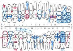 39 Best Dental Charting Images In 2019 Dental Dental